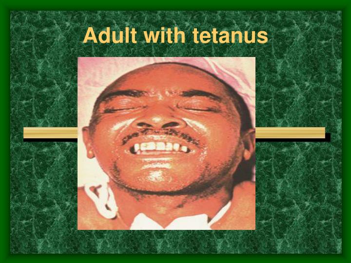 Adult Tetanus 102