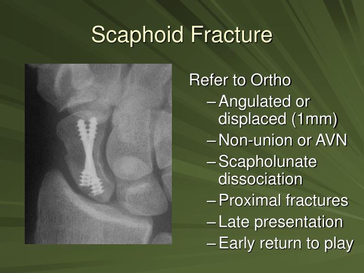 scaphoid pain but no fracture scaphoid pain but no fracture