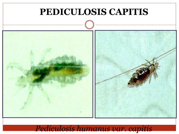 pediculosis capitis