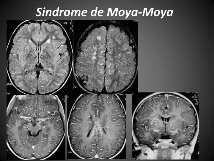 PPT Sindrome de MoyaMoya PowerPoint Presentation ID4358442