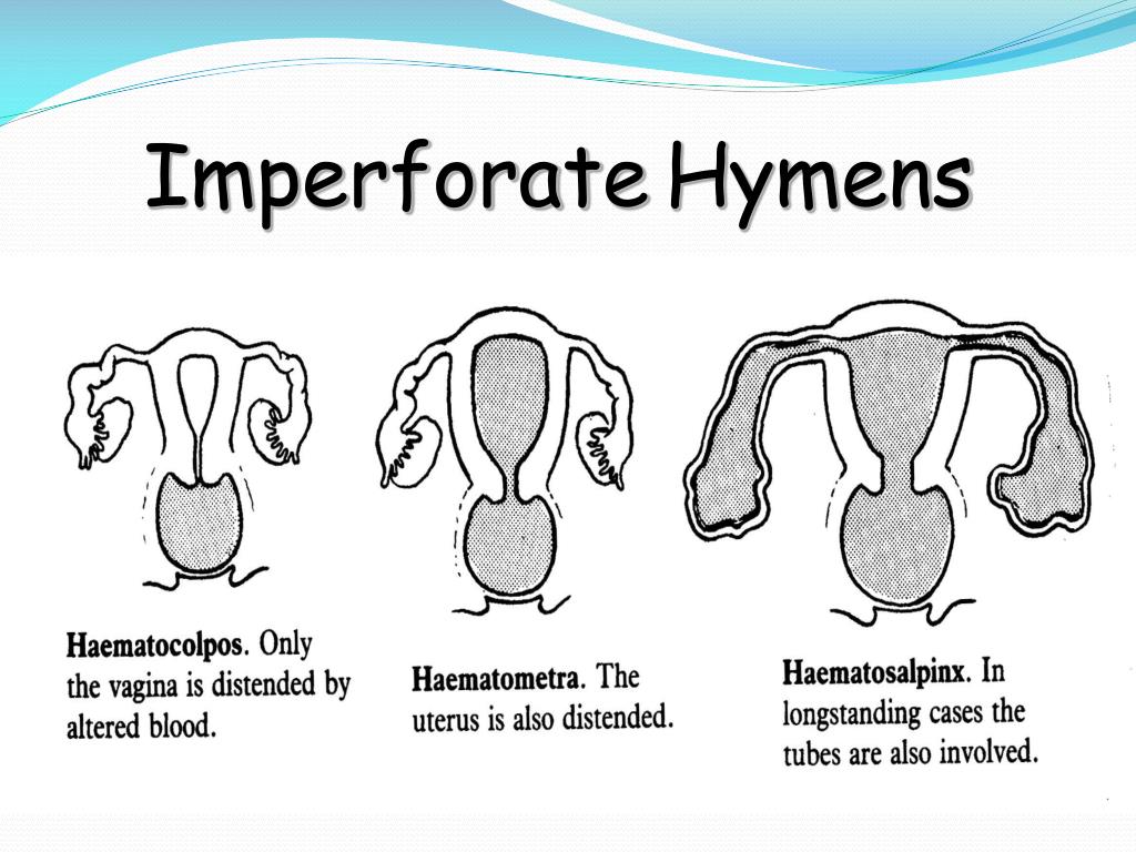What dose a hymen look like