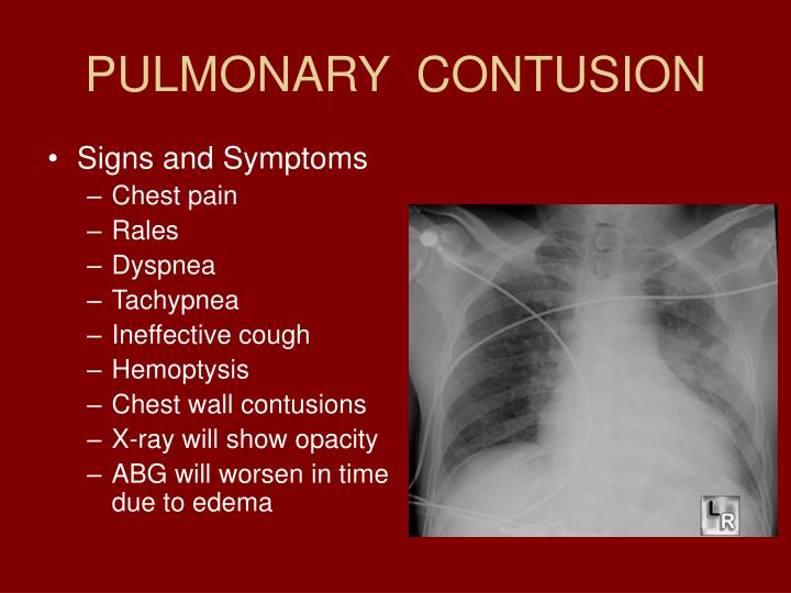 Chest Contusion Healing Time Deep Tissue Contusion Healing Time