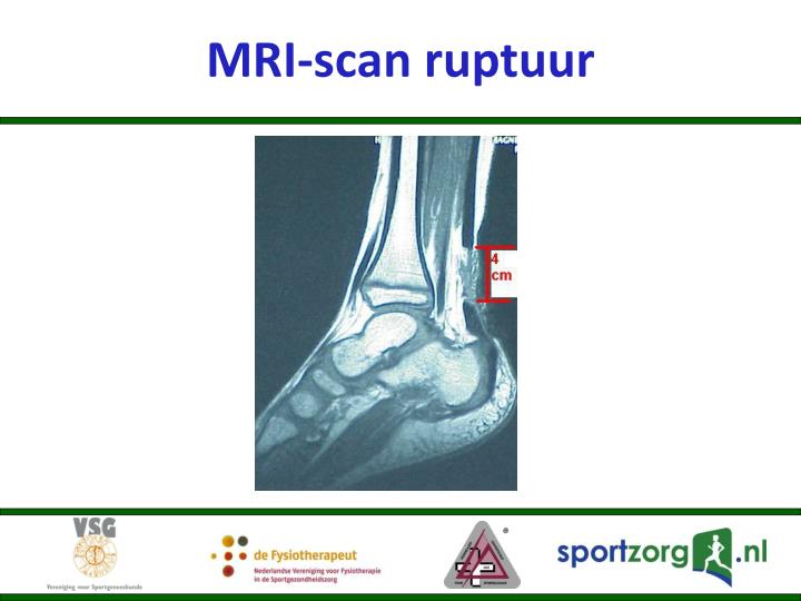 mri scan voet