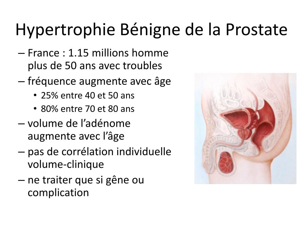PPT Hypertrophie Bénigne de la Prostate PowerPoint Presentation free