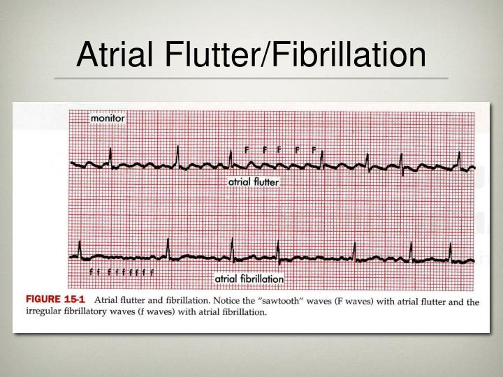 atrial flutter vs atrial fibrillation