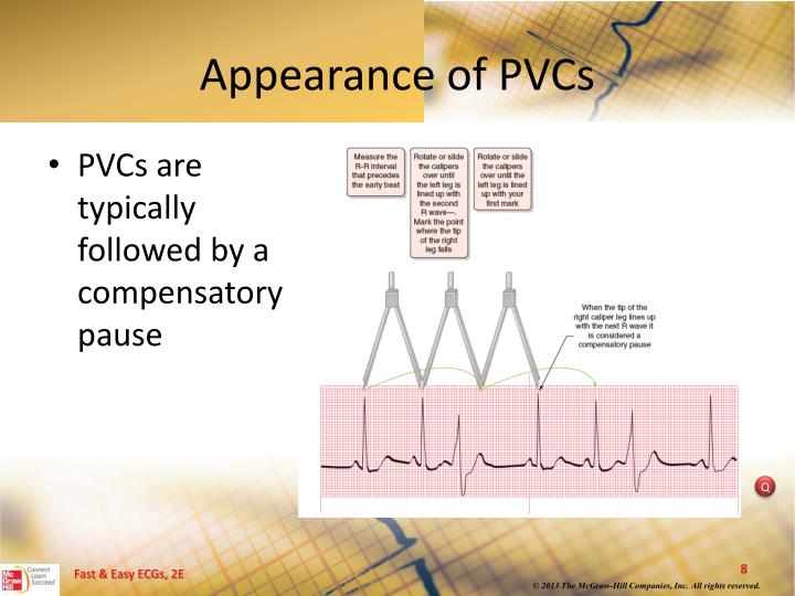 PPT Ventricular Dysrhythmias PowerPoint Presentation ID5204970