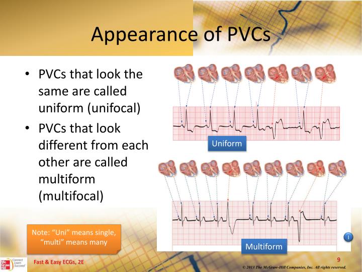 PPT Ventricular Dysrhythmias PowerPoint Presentation ID5204970