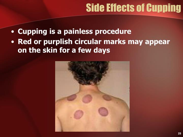 PPT Al Hijama (Cupping Therapy) PowerPoint Presentation ID3617259