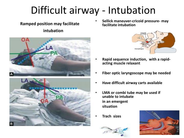 Timing difficult. Rapid Intubation. The difficult Airway.