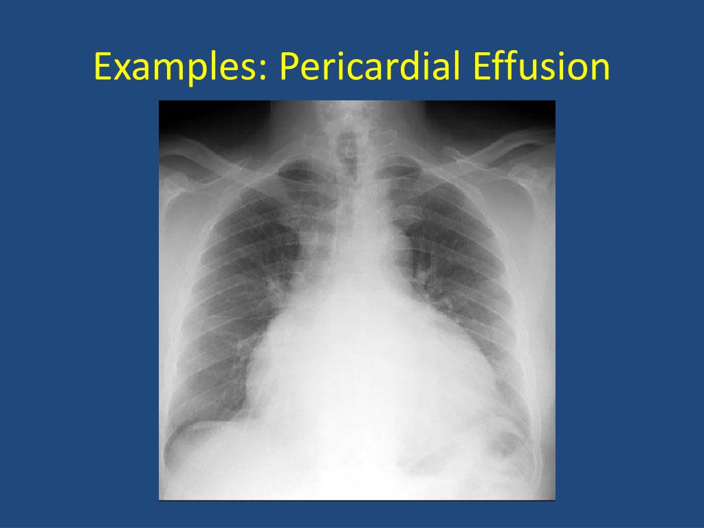 PPT Basics Of Chest X Ray PowerPoint Presentation Free Download ID 