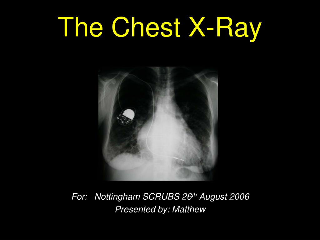 Ppt The Chest X Ray Powerpoint Presentation Free Download Id 3620595