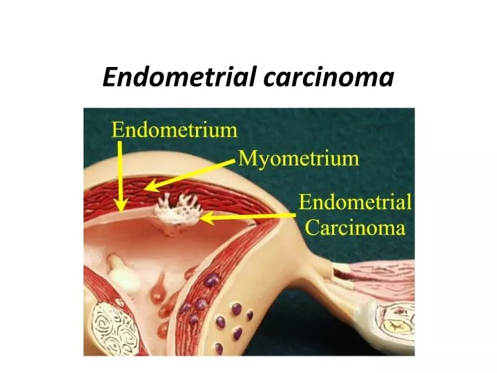 Cancer endometrial ppt,