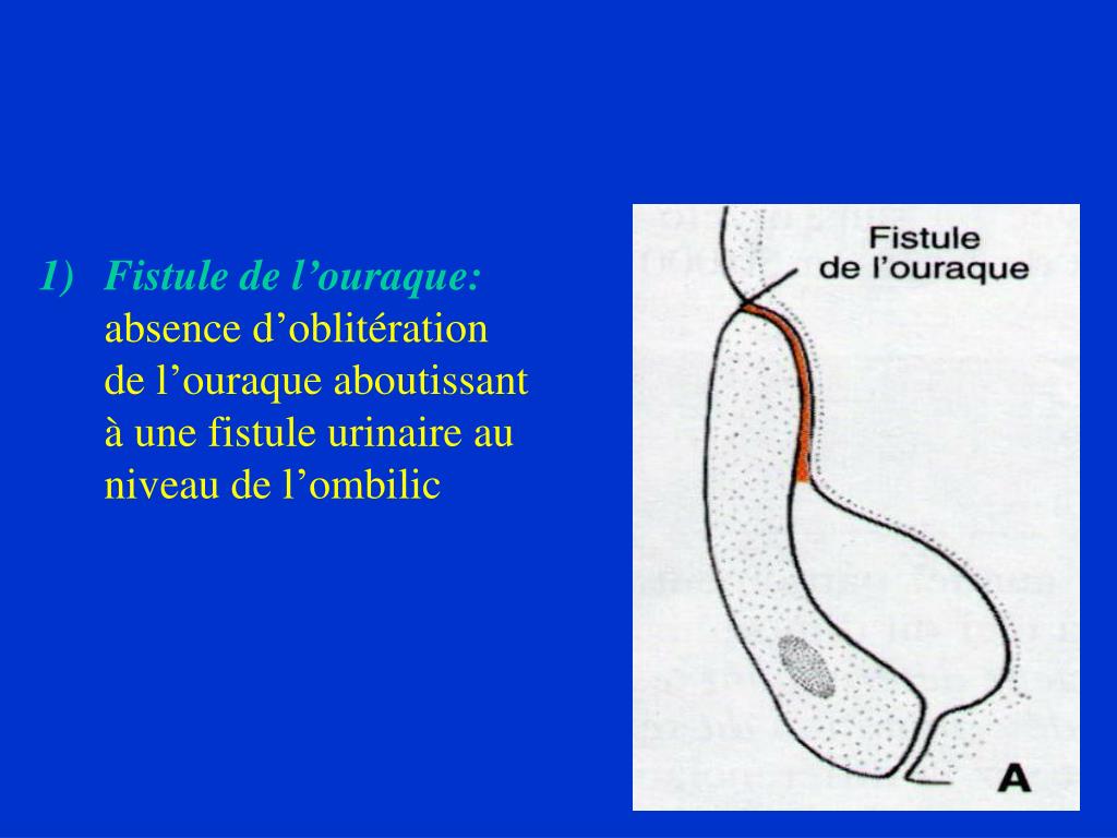 PPT MALFORMATIONS UROGENITALES PowerPoint Presentation Free Download PPT MALFORMATIONS UROGENITALES PowerPoint Presentation Free Download