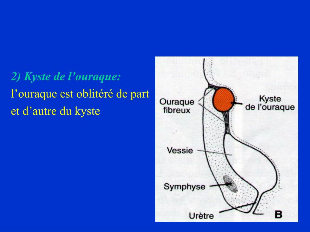 PPT MALFORMATIONS UROGENITALES PowerPoint Presentation Free Download PPT MALFORMATIONS UROGENITALES PowerPoint Presentation Free Download