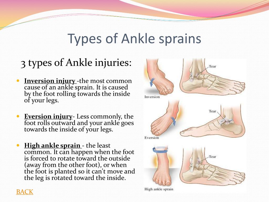 PPT - Ankle Injuries PowerPoint Presentation, free download - ID:3630042