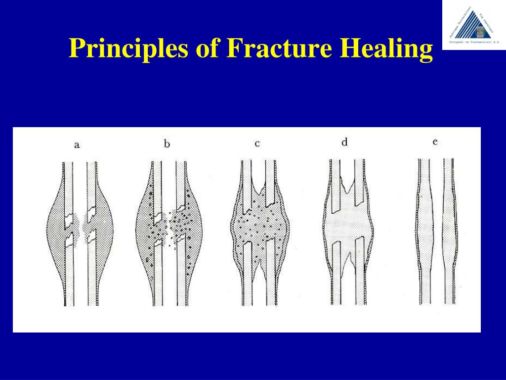 Ppt Principles Of Fracture Healing Powerpoint Presentation Free