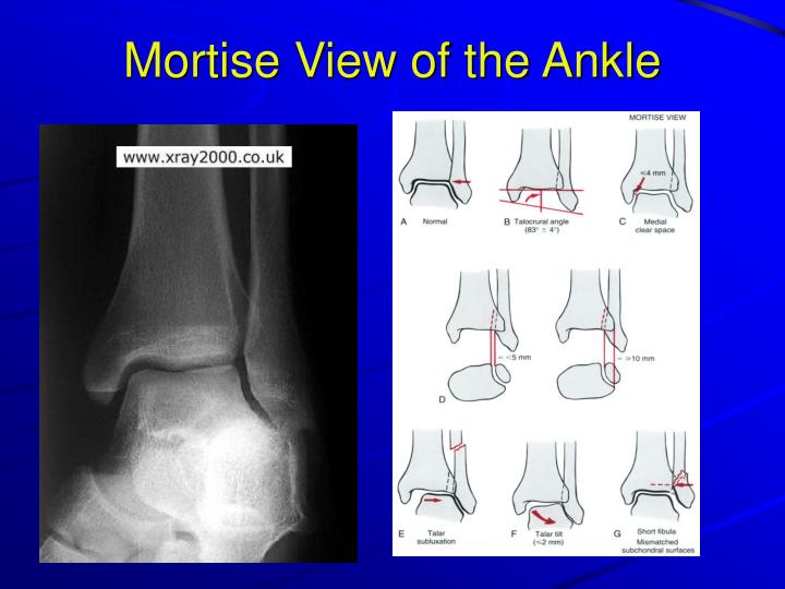 PPT XRay Rounds (Plain) Radiographic Evaluation of the Ankle