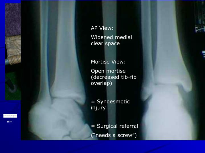 PPT - X-Ray Rounds: (Plain) Radiographic Evaluation of the Ankle ...