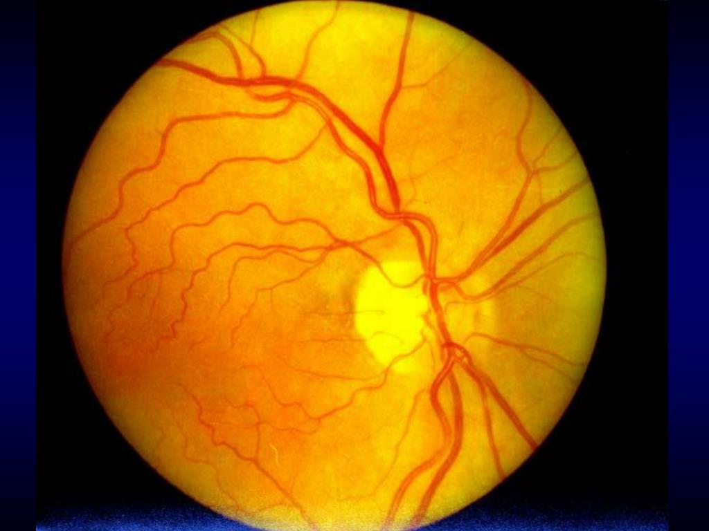 Изменение на глазном дне. Гипертоническая ретинопатия глазное дно. Ангиоспастическая ретинопатия. Гипертоническая ангиопатия и ретинопатия. Посттромботическая ретинопатия.
