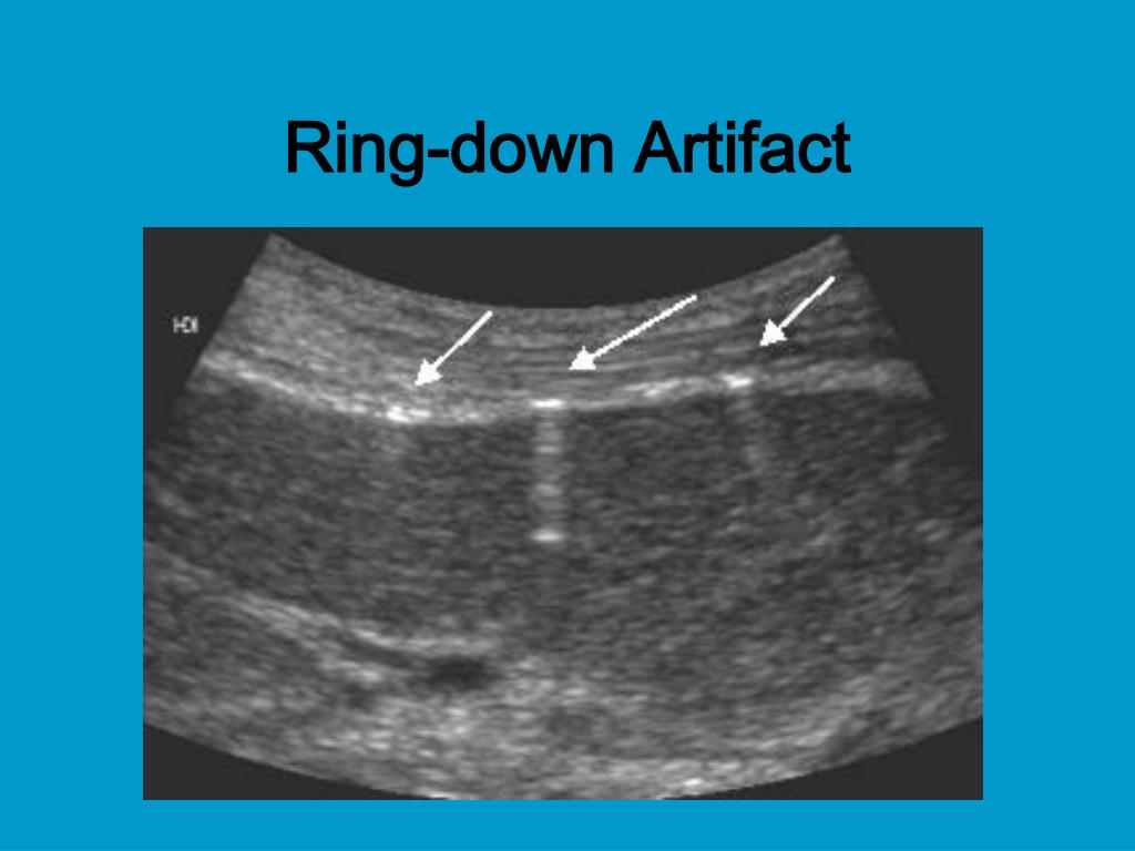Echocardiographic characteristics of venous air embolism presenting as  reversible pulmonary atresia in a premature neonate | Cardiology in the  Young | Cambridge Core