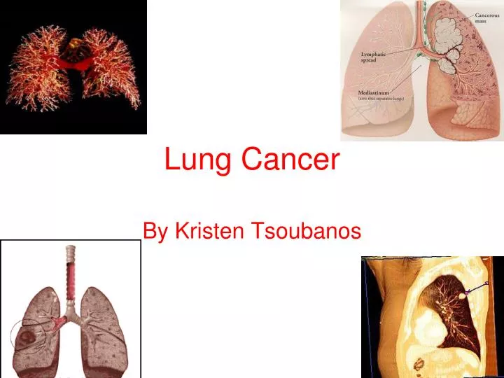 PPT Lung Cancer PowerPoint Presentation Free Download ID 3665214