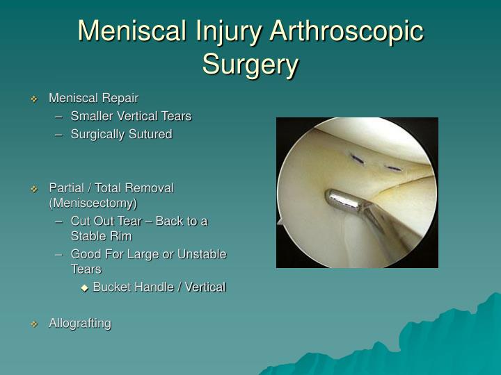 meniscal injuries An mri revealed that timberwolves guard jimmy butler suffered a right meniscus injury butler avoids acl tear, has injured meniscus minnesota timberwolves. meniscal injuries An mri revealed that timberwolves guard jimmy butler suffered a right meniscus injury butler avoids acl tear, has injured meniscus minnesota timberwolves.