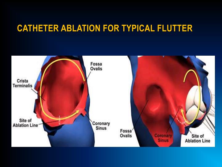 Atrial flutter ablation procedure - serykool
