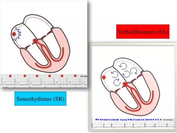 PPT - Sinusrhythmus (SR) PowerPoint Presentation, free download - ID ...