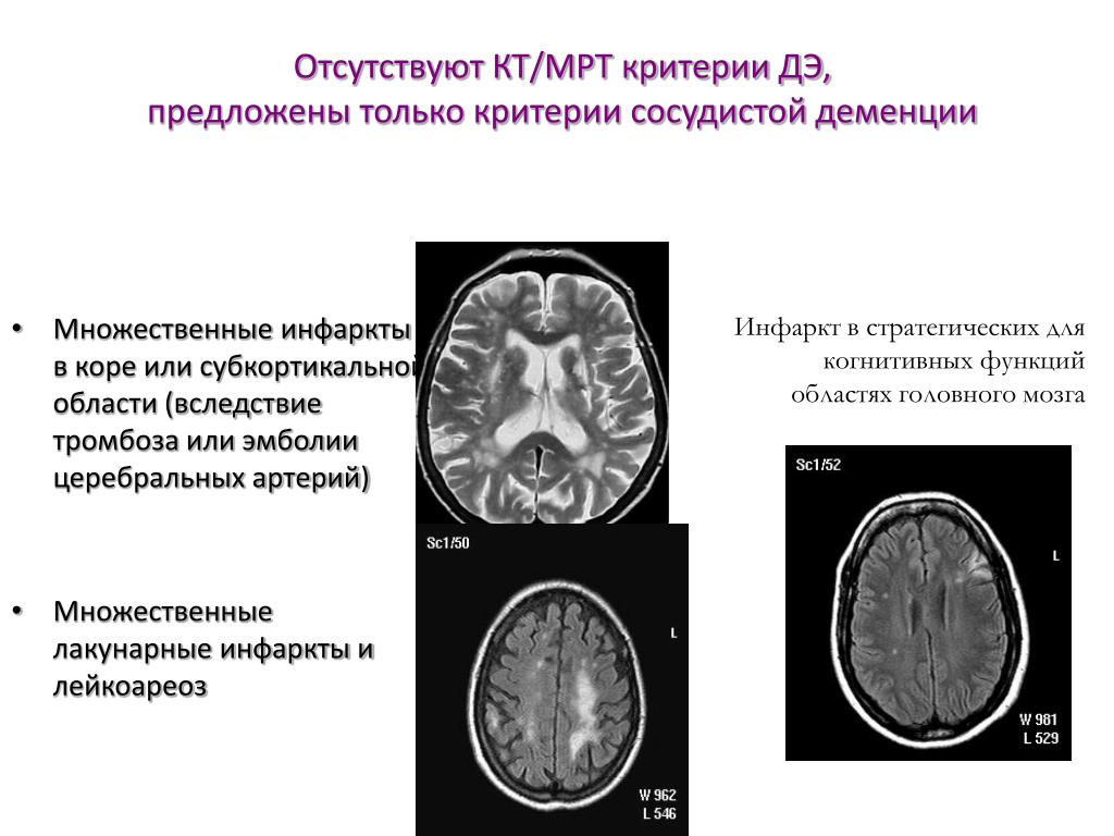 Деменция на мрт. Кт головного мозга при дисциркуляторной энцефалопатии. Перивентрикулярный лейкоареоз на кт. Деменция на мрт головного мозга. Дисциркуляторная энцефалопатия мрт.