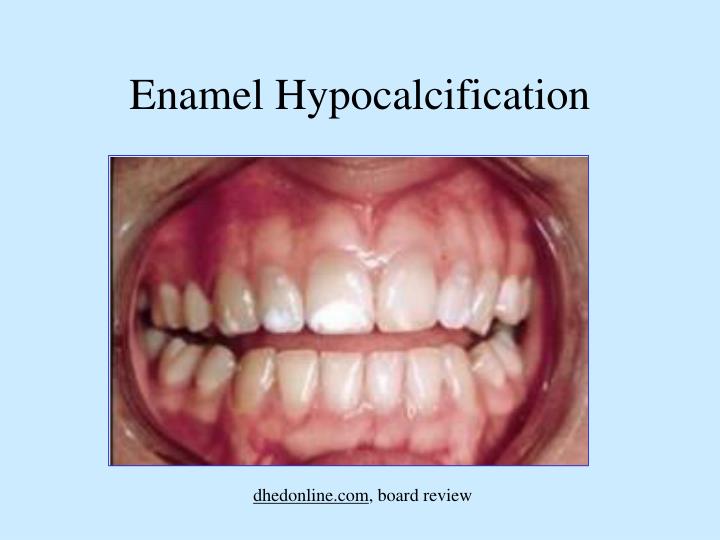 PPT - Dental Anomalies PowerPoint Presentation - ID:3700780