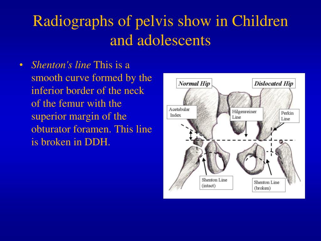 PPT - Develompmental Dysplasia of the Hip (DDH) . PowerPoint ...