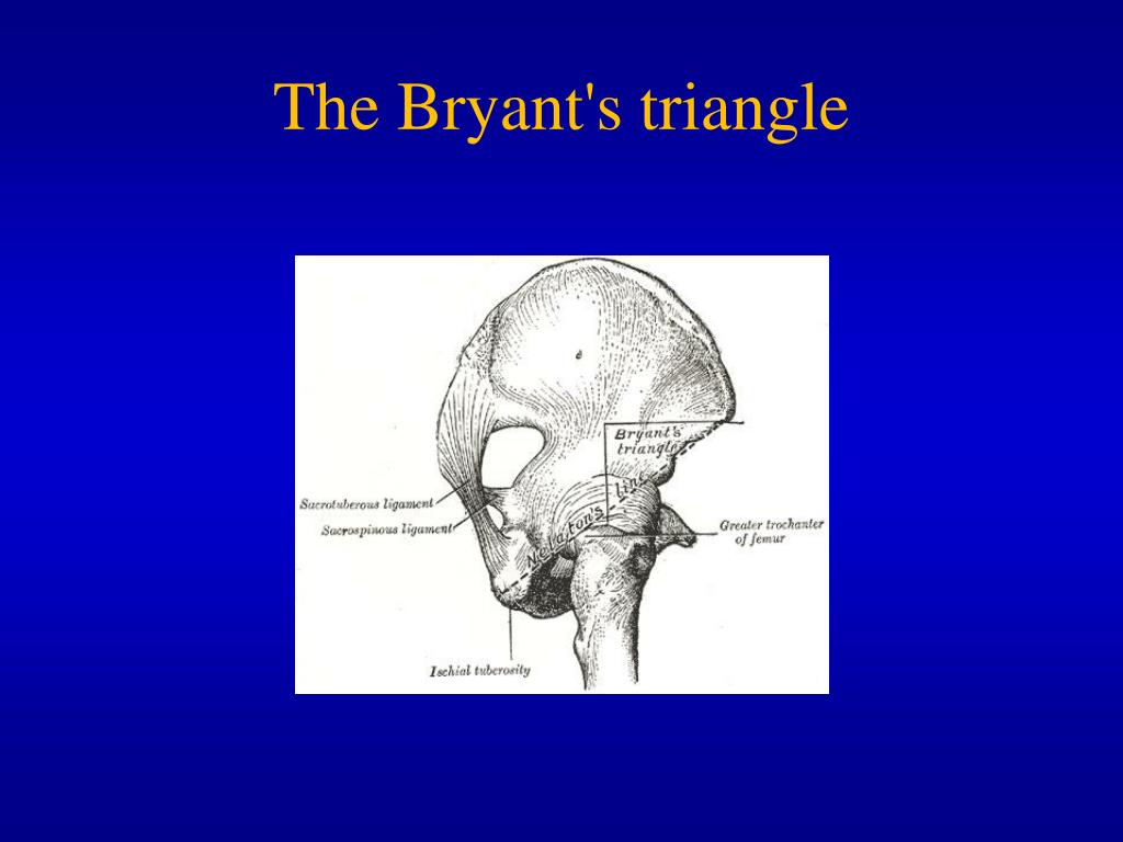 PPT Develompmental Dysplasia Of The Hip DDH PowerPoint PPT Develompmental Dysplasia Of The Hip DDH PowerPoint