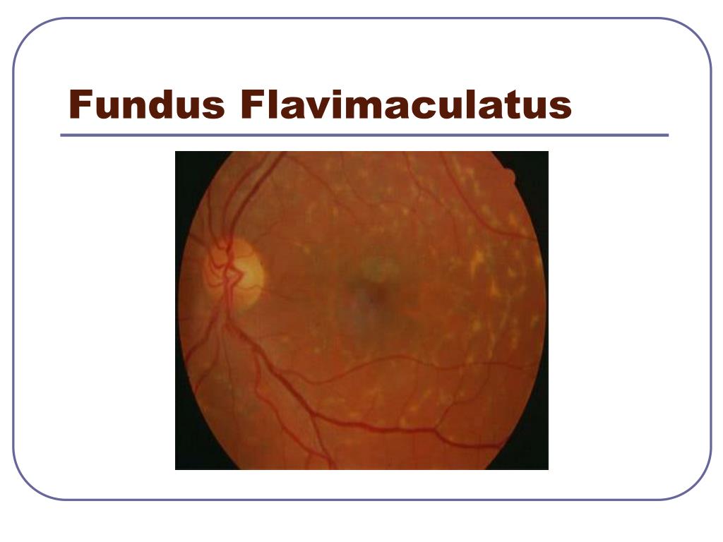 PPT Less Common Ocular Diseases PowerPoint Presentation Free 