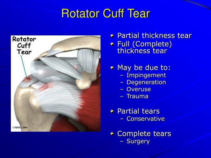 Rotator Cuff Tear Grades