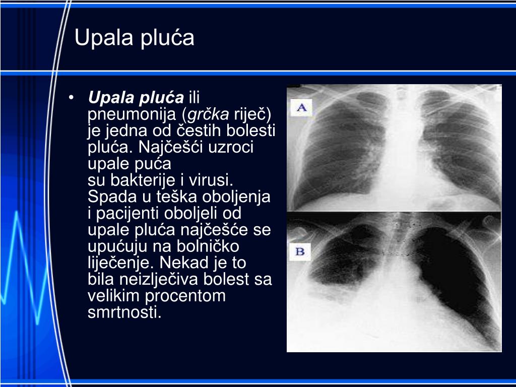 Bolesti dišnog sustava prezentacija