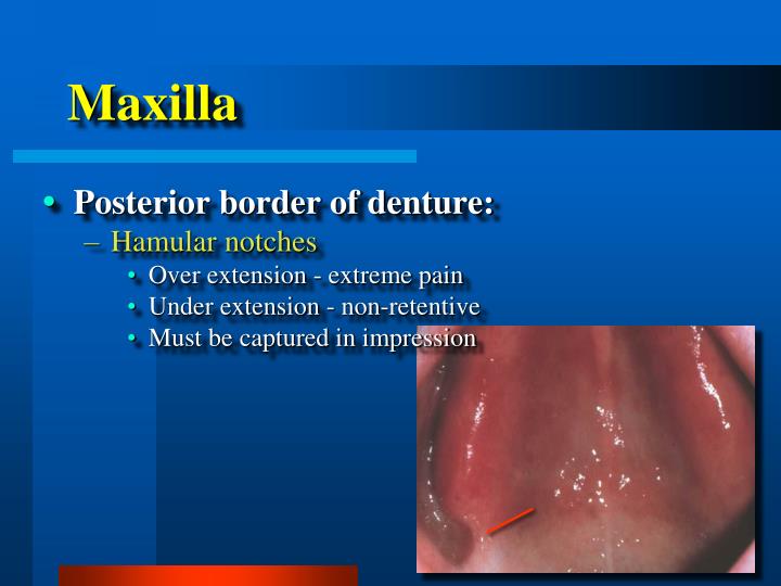 hamular notch