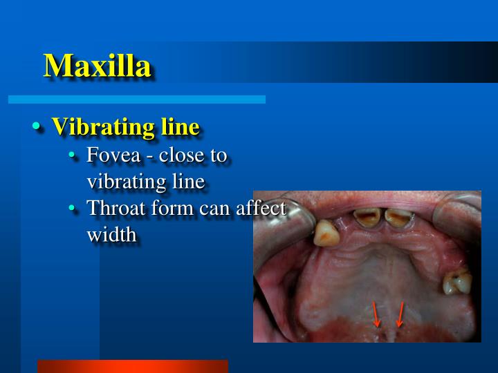 PPT Complete Denture Diagnosis & Treatment Planning PowerPoint