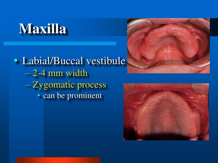 PPT Complete Denture Diagnosis & Treatment Planning PowerPoint