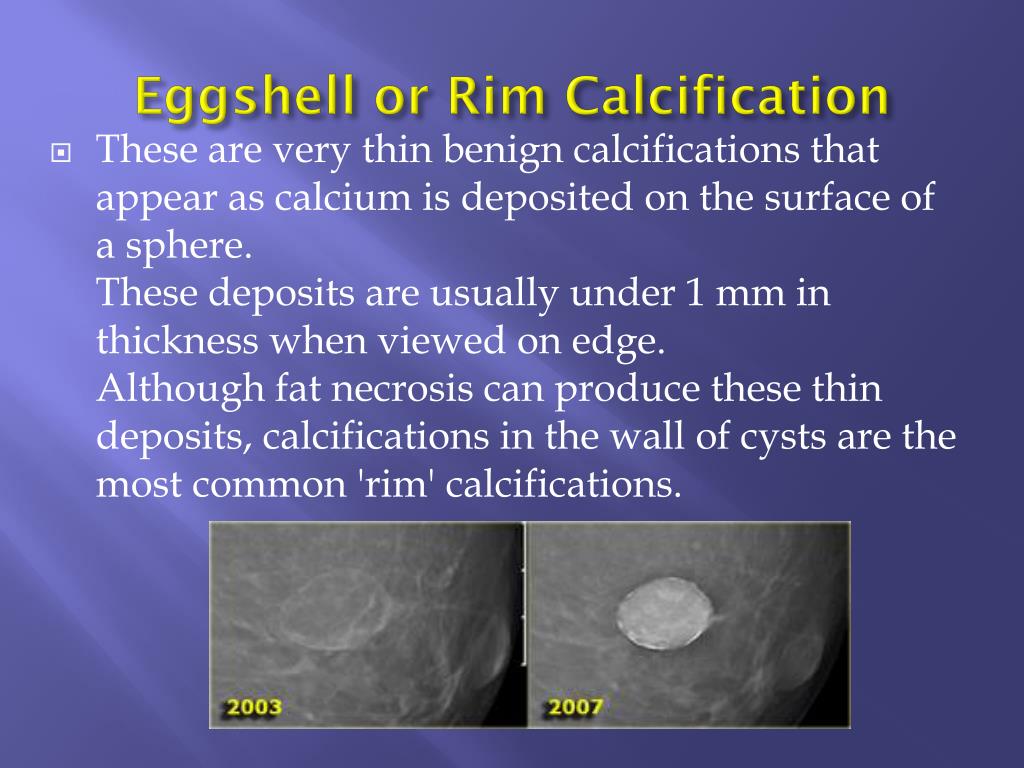 PPT Breast Calcifications Differential Diagnosis And BIRADS 