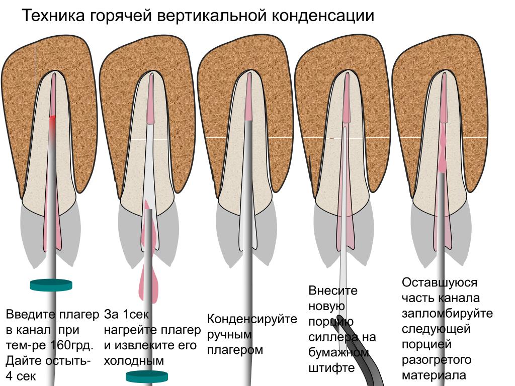 Пасты пломбирования каналов зубов