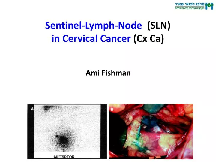 sentinel lymph node sln in cervical cancer cx ca n.