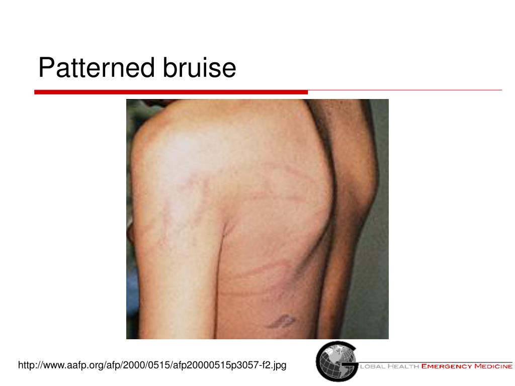 PPT Suspected Child Abuse and Neglect PowerPoint Presentation, free