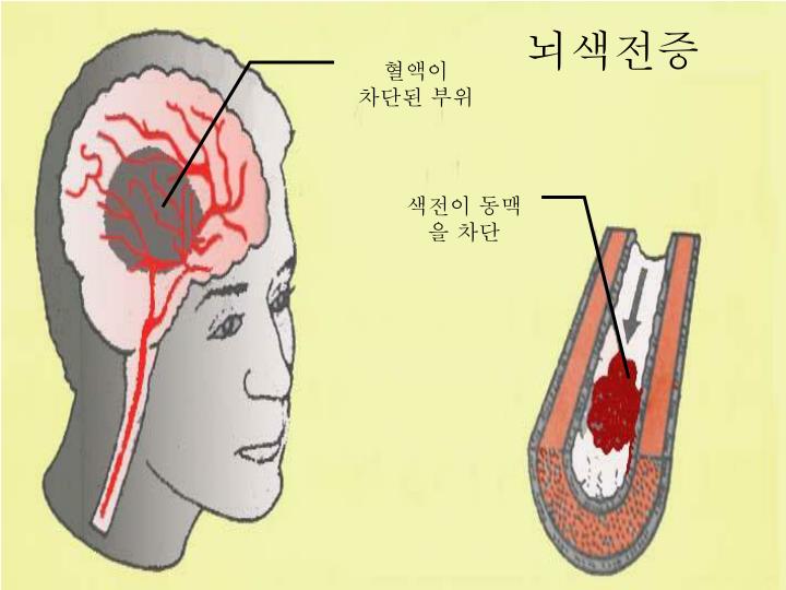 PPT - 치매의 증상과 진행과정 PowerPoint Presentation - ID:3740017