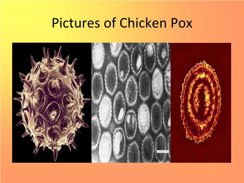 PPT - Chicken Pox PowerPoint Presentation, free download - ID:3746562
