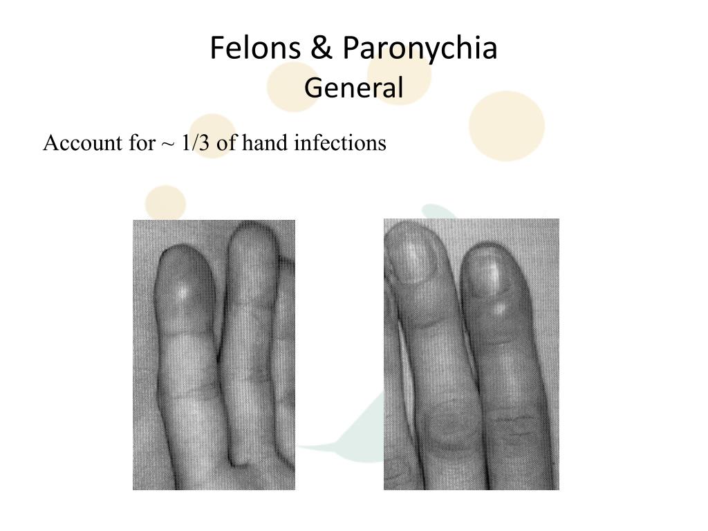 PPT Hand Infections PowerPoint Presentation Free Download ID 3753697 PPT Hand Infections PowerPoint Presentation Free Download ID 3753697