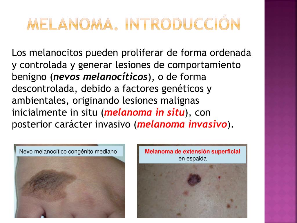 PPT CÁNCER DE PIEL(I). MELANOMA PowerPoint Presentation, free