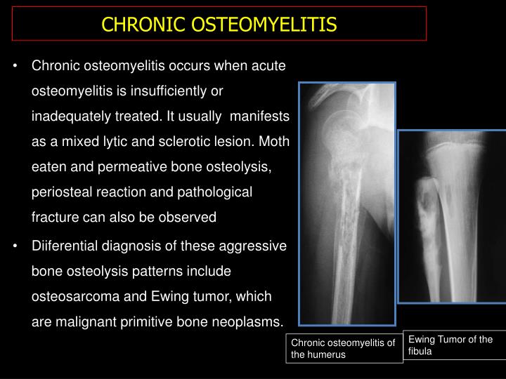 PPT BONE INFECTION MIMICKING BONE TUMORS HOW TO MAKE THE DISTINCTION