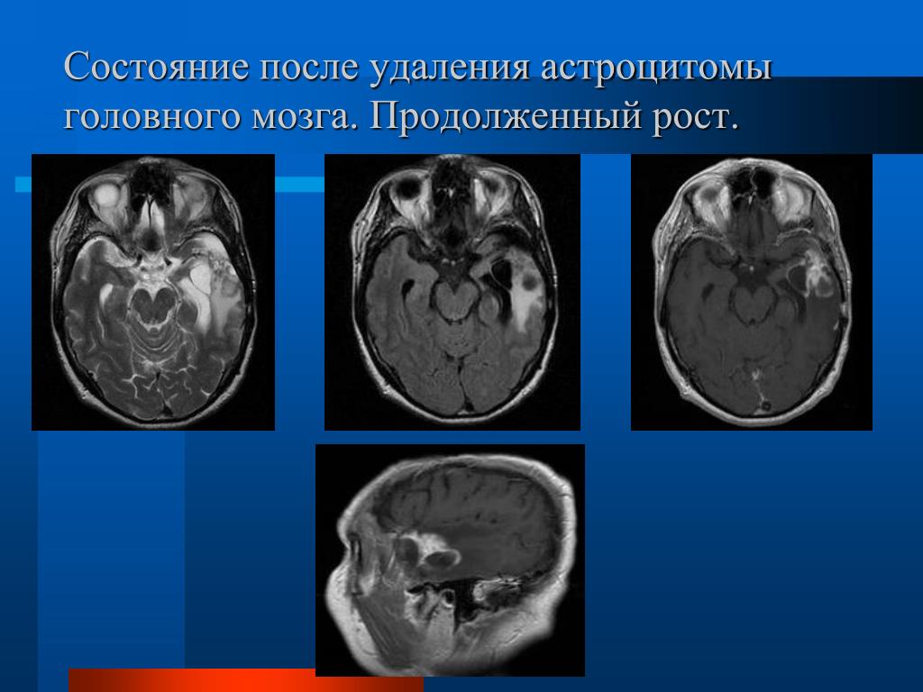 Астроцитома головного мозга прогноз. Астроцитома головного мозга. Самочувствие после мрт. Астроцитомы головного мозга человека-.