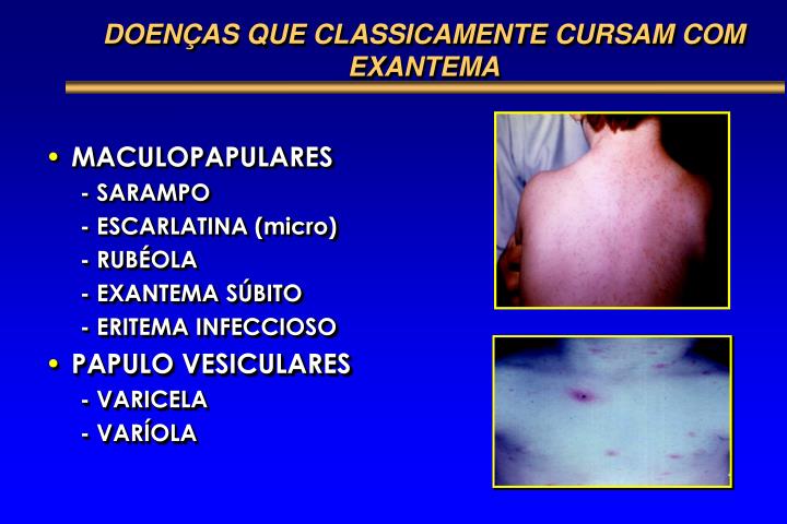 PPT - Doenças Exantemáticas DIAGNÓSTICO DIFERENCIAL PowerPoint ...