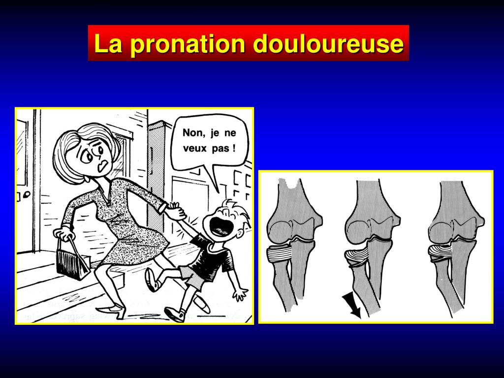 PPT - La pronation douloureuse PowerPoint Presentation, free download -  ID:3818904